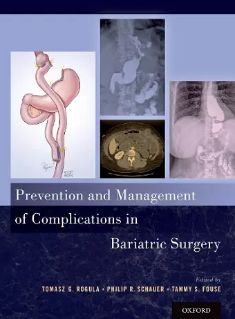 Prevention and Management of Complications in Bariatric Surgery cover