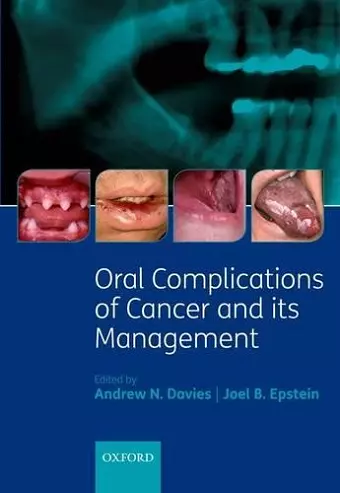 Oral Complications of Cancer and its Management cover