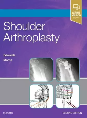 Shoulder Arthroplasty cover