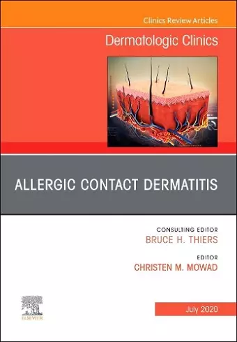 Allergic Contact Dermatitis,An Issue of Dermatologic Clinics cover