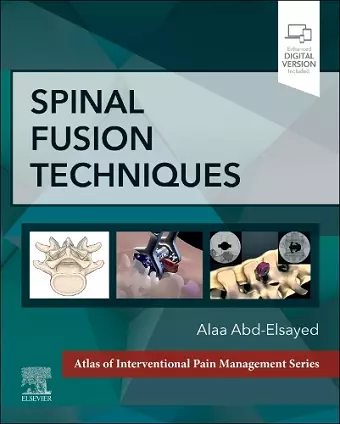 Spinal Fusion Techniques cover