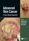 Advanced Skin Cancer cover