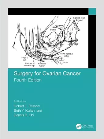 Surgery for Ovarian Cancer cover