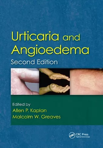 Urticaria and Angioedema cover