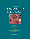 Atlas of Transvaginal Endoscopy cover