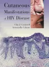 Cutaneous Manifestations of HIV Disease cover