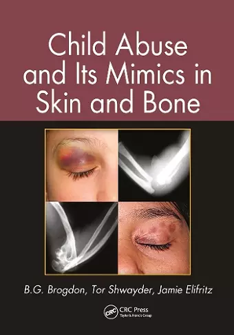 Child Abuse and its Mimics in Skin and Bone cover