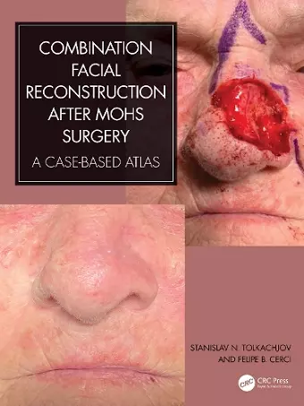 Combination Facial Reconstruction after Mohs Surgery cover