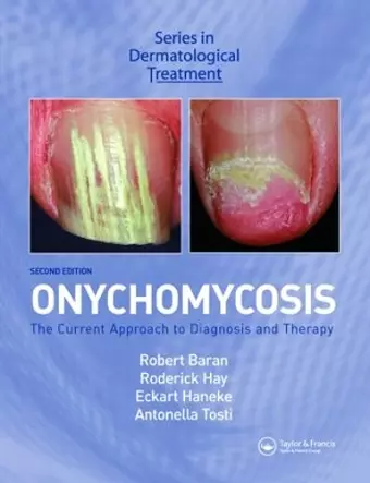 Onychomycosis cover