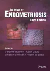 Atlas of Endometriosis cover