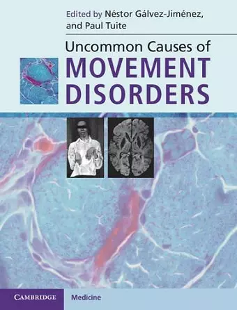 Uncommon Causes of Movement Disorders cover