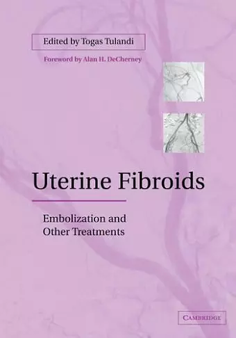 Uterine Fibroids cover