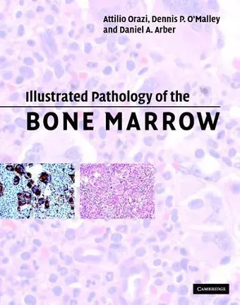 Illustrated Pathology of the Bone Marrow cover