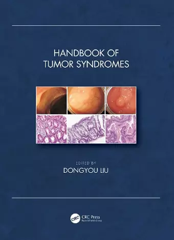 Handbook of Tumor Syndromes cover