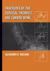 Fractures of the Cervical, Thoracic, and Lumbar Spine cover