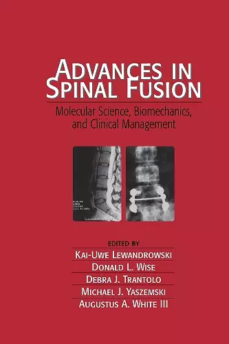 Advances in Spinal Fusion cover