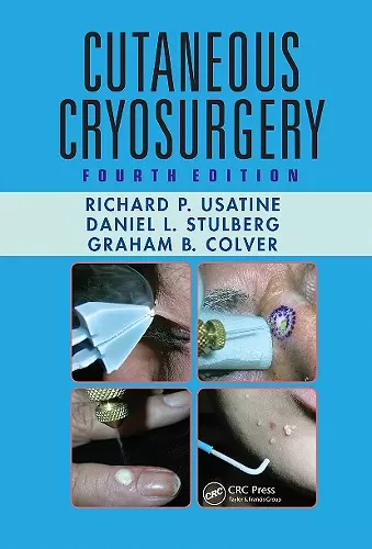 Cutaneous Cryosurgery cover