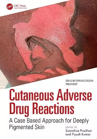 Cutaneous Adverse Drug Reactions cover