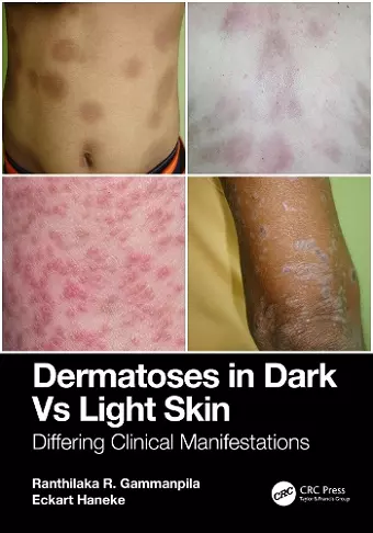 Dermatoses in Dark Vs Light Skin cover