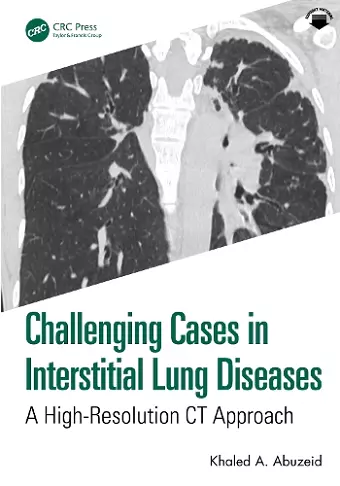 Challenging Cases in Interstitial Lung Diseases cover