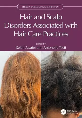 Hair and Scalp Disorders Associated with Hair Care Practices cover