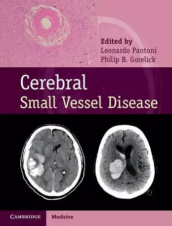 Cerebral Small Vessel Disease cover