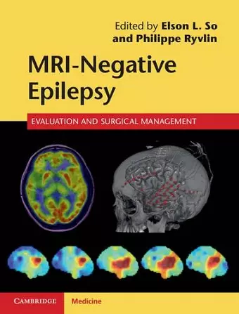 MRI-Negative Epilepsy cover