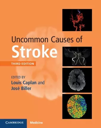 Uncommon Causes of Stroke cover