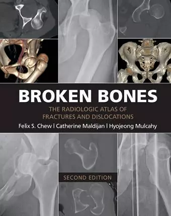 Broken Bones cover