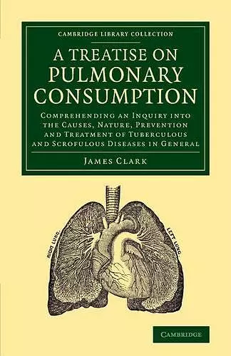 A Treatise on Pulmonary Consumption cover