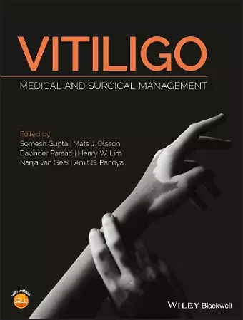 Vitiligo cover