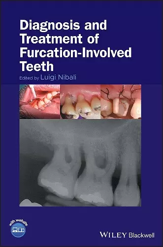 Diagnosis and Treatment of Furcation-Involved Teeth cover