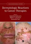 Dermatologic Reactions to Cancer Therapies cover