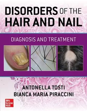 Disorders of the Hair and Nail: Diagnosis and Treatment cover