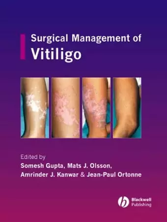 Surgical Management of Vitiligo cover