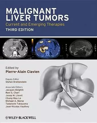 Malignant Liver Tumors cover