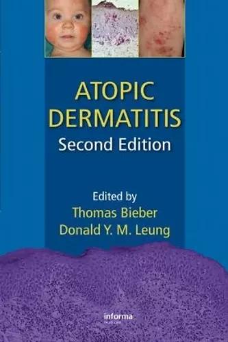 Atopic Dermatitis cover