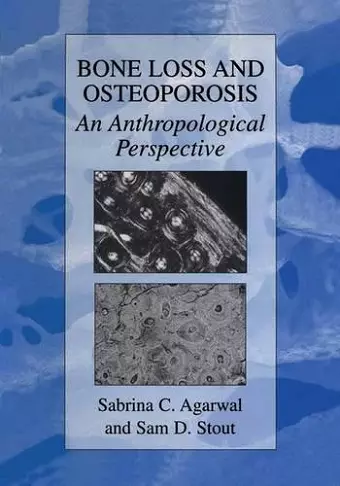 Bone Loss and Osteoporosis cover