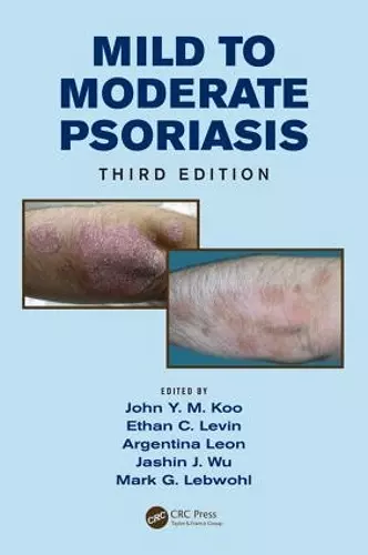 Mild to Moderate Psoriasis cover