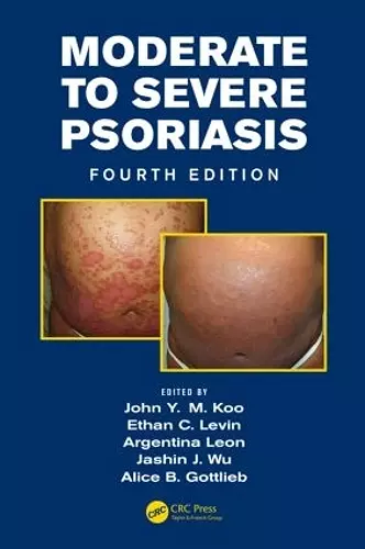 Moderate to Severe Psoriasis cover