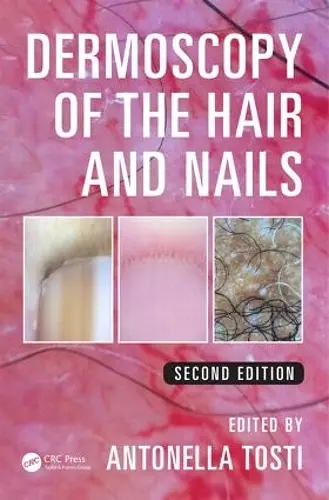 Dermoscopy of the Hair and Nails cover