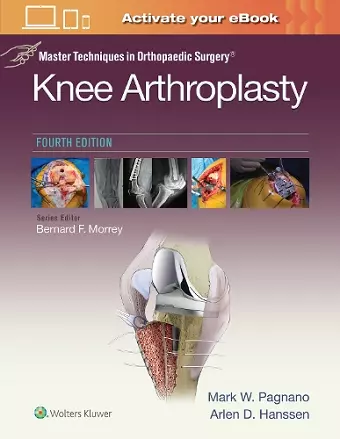 Master Techniques in Orthopedic Surgery: Knee Arthroplasty cover