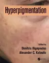 Hyperpigmentation cover