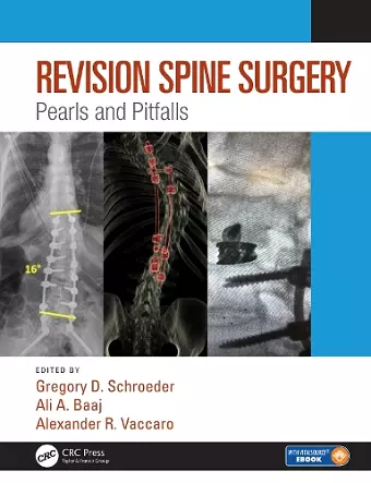 Revision Spine Surgery cover