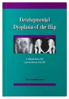 Developmental Dysplasia of the Hip cover