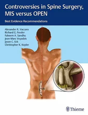 Controversies in Spine Surgery, MIS versus OPEN cover