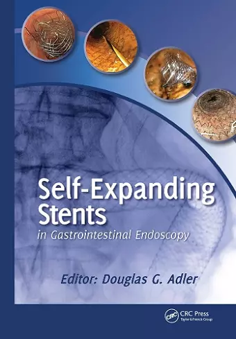 Self-Expanding Stents in Gastrointestinal Endoscopy cover