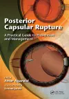 Posterior Capsular Rupture cover