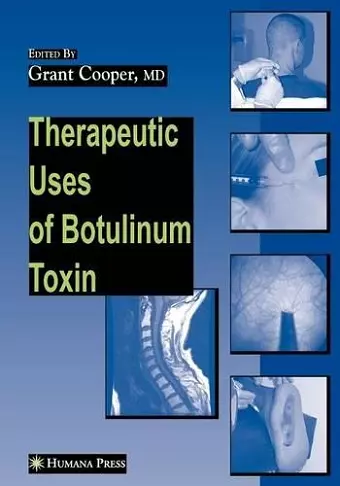 Therapeutic Uses of Botulinum Toxin cover