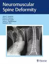 Neuromuscular Spine Deformity cover